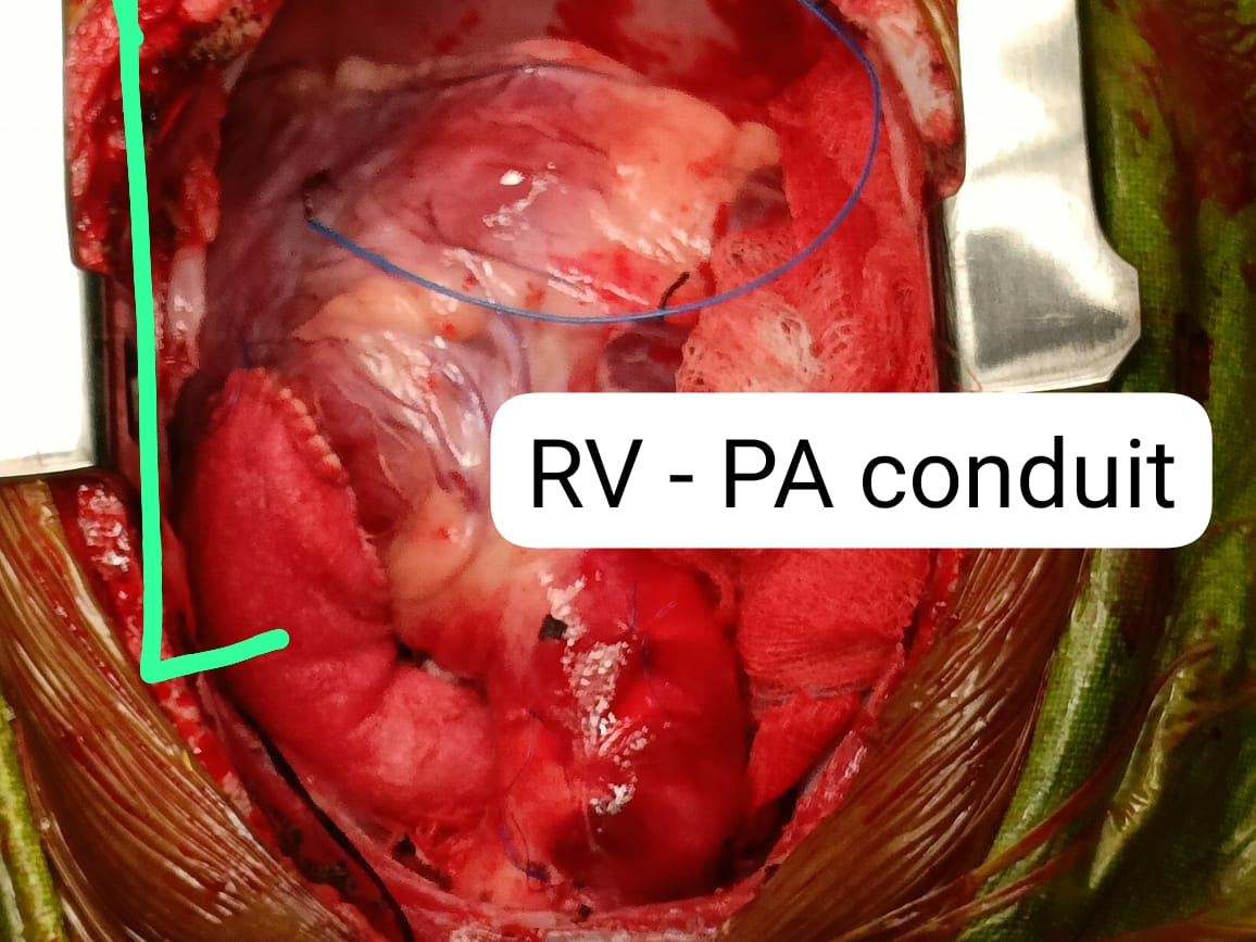 Understanding CTVS: A Lifeline for Cardiac Patients